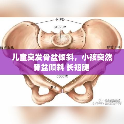 兒童突發(fā)骨盆傾斜，小孩突然骨盆傾斜 長短腿 