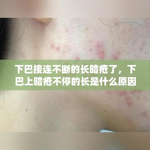 下巴接連不斷的長暗瘡了，下巴上暗瘡不停的長是什么原因 