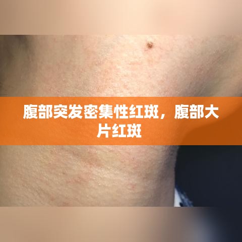 腹部突發(fā)密集性紅斑，腹部大片紅斑 